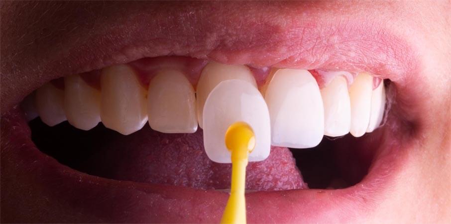 Imagem das Facetas em porcelana