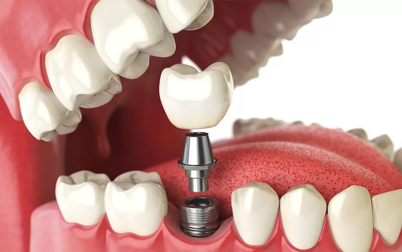 Imagem dos implantes dentarios
